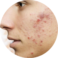 Inflammatory acne example