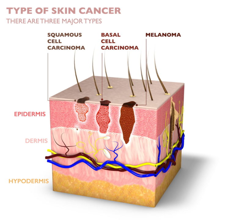 Diagram of types of skin cancer.