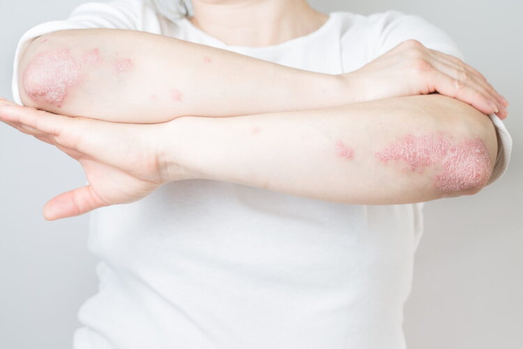 Arms with Psoriasis.