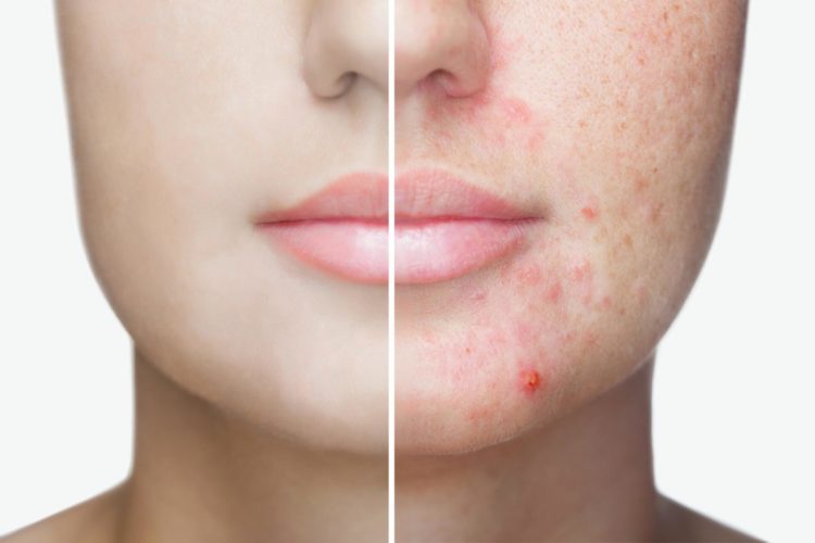 Before and after the dermatological treatment treatment