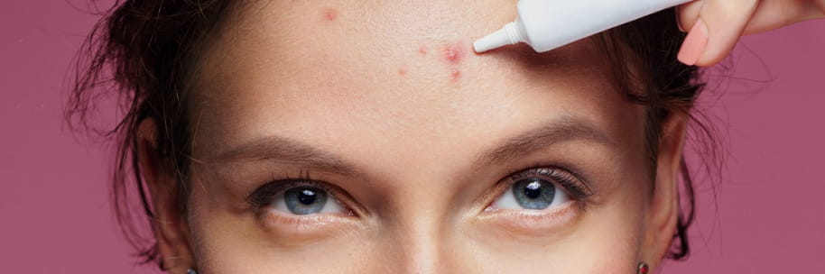 Woman with some pimples on her forehead, putting anti-acne cream