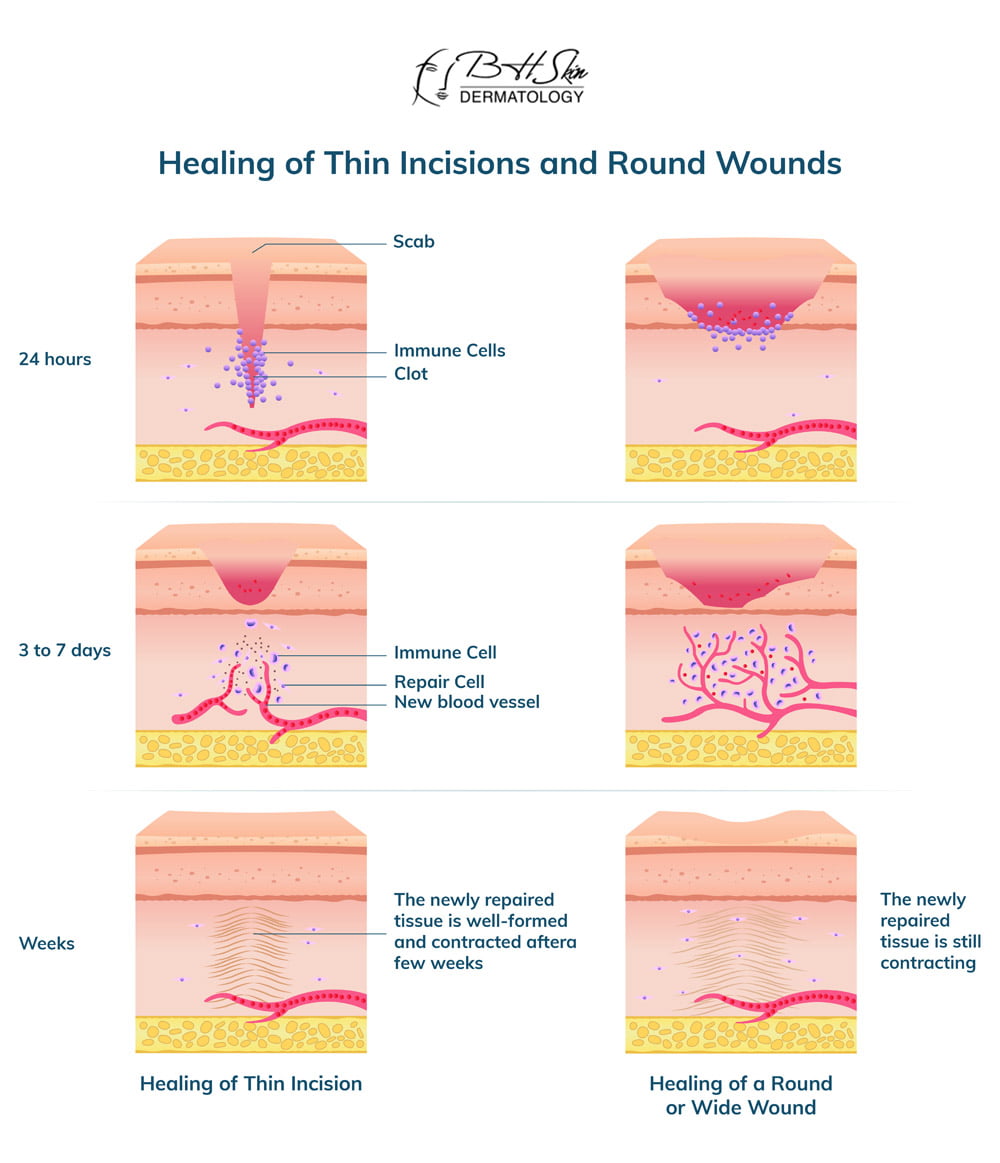 How Do Surgical Incisions Heal At Juan White Blog