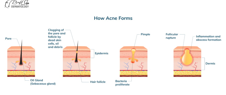 Best Acne Scar Removal Treatments & Products (Complete Guide)