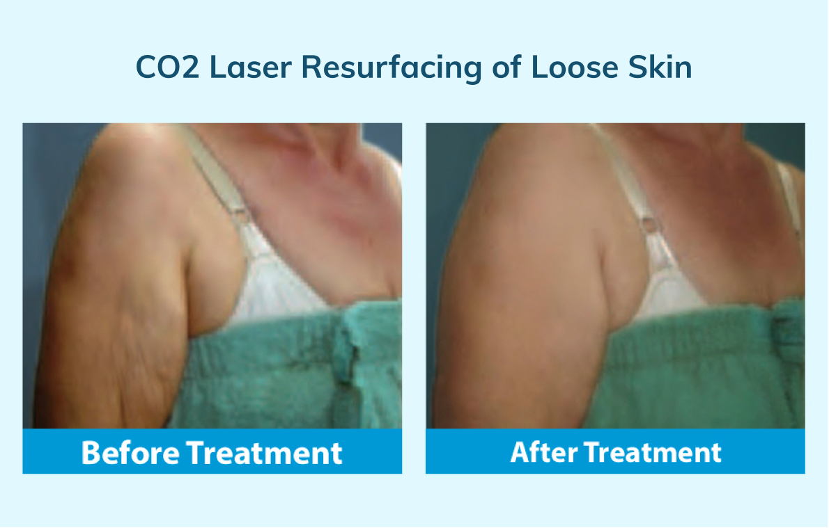 co2 laser before and after