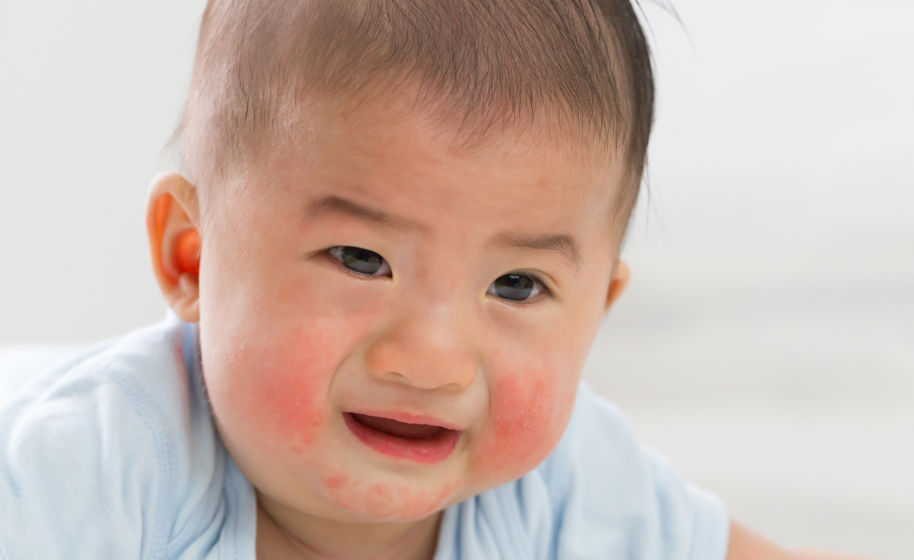 Eczema for babys